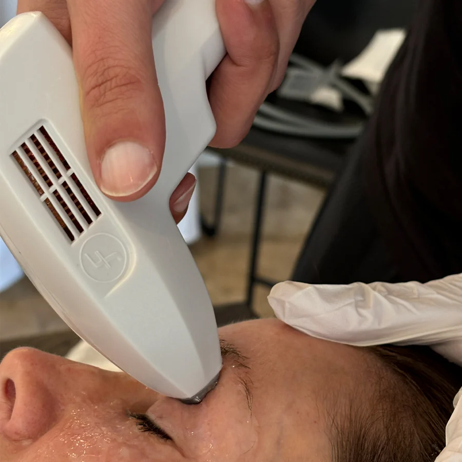 In-office IPL treatment for dry eye and meibomian gland dysfunction at Glimpse Vision