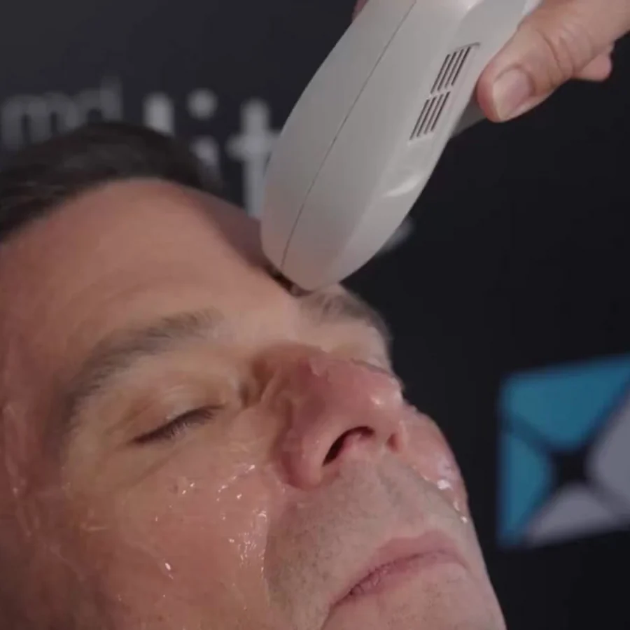 IPL treatment being performed around the eyes at Glimpse Vision in Chicago