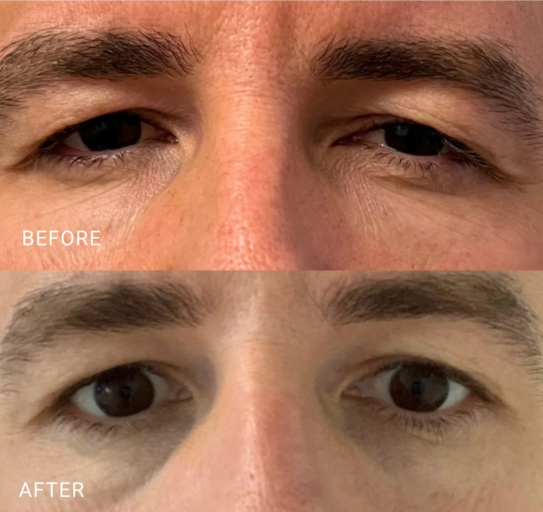Before and after IPL and radiofrequency treatment for upper and lower eyelid laxity at Glimpse Vision