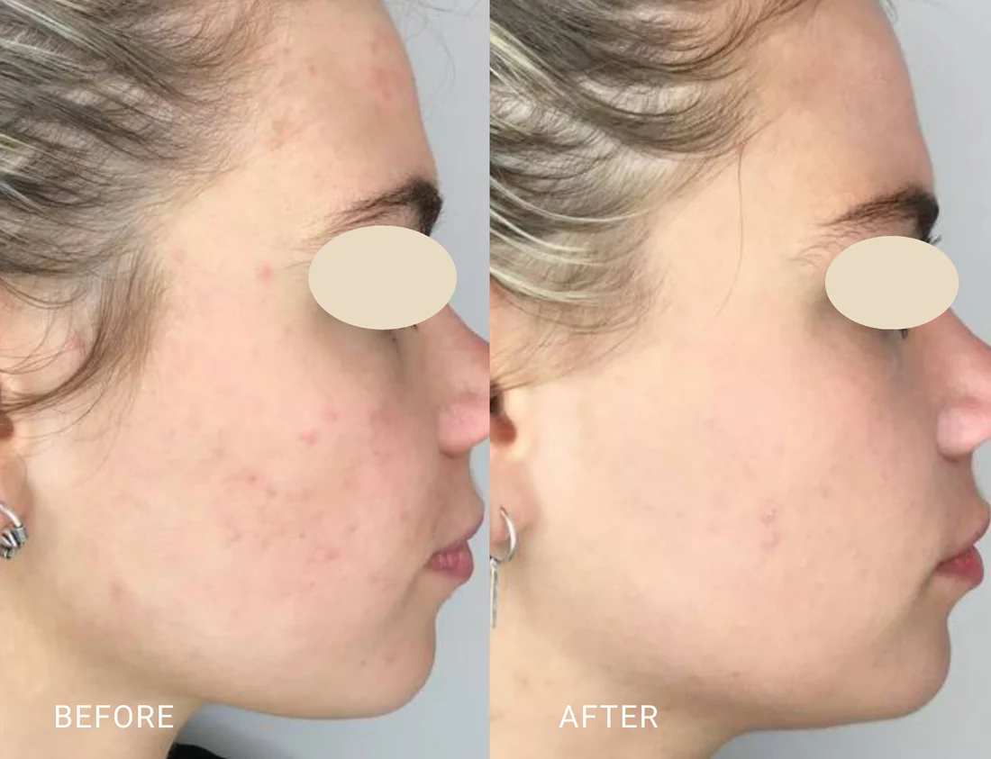 Before and after IPL treatment showing reduced redness and inflammation around the eyes
